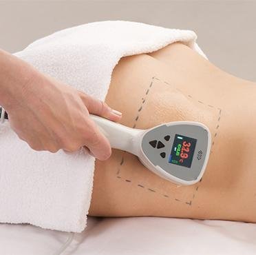 Skin tightening2 1
