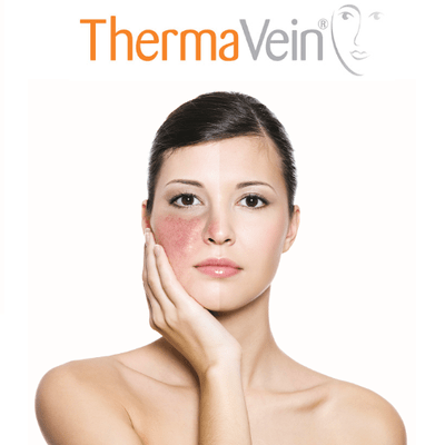 Thermavein